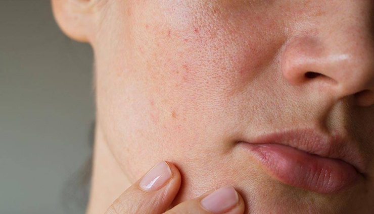 home remedies,home remedies for acne marks,acne marks removal tips,beauty tips,skin care tips