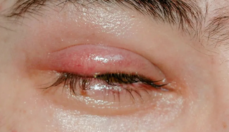 8 Effective Home Remedies To Help You Get Rid of Stye