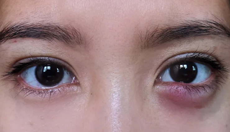 swollen eyelids,causes of eyelid swelling,puffy eyelids,eye inflammation,orbital cellulitis,graves’ disease,ocular herpes,eye allergy symptoms,swollen eye treatment,upper eyelid swelling,home remedies for swollen eyelids,red and swollen eyelid