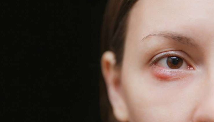 home remedies,home remedies for stye in eyes,stye in eyes,Health tips