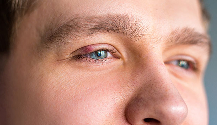 styes in eyes,ways to prevent styes in eyes,Health tips,fitness tips,eye care tips