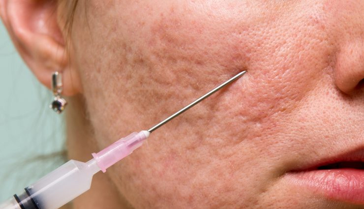 pitted acne scars remedies,acne scar treatment methods,home remedies for acne pitting,natural remedies for pitted scars,treating indented acne scars naturally,diy remedies for pitted acne scars,effective treatments for depressed acne scars,how to heal pitted acne scars,scar reduction remedies,skin care for pitted acne scars