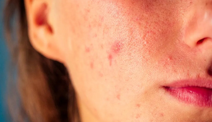 10 DIY Ways To Treat Summer Acne at Home