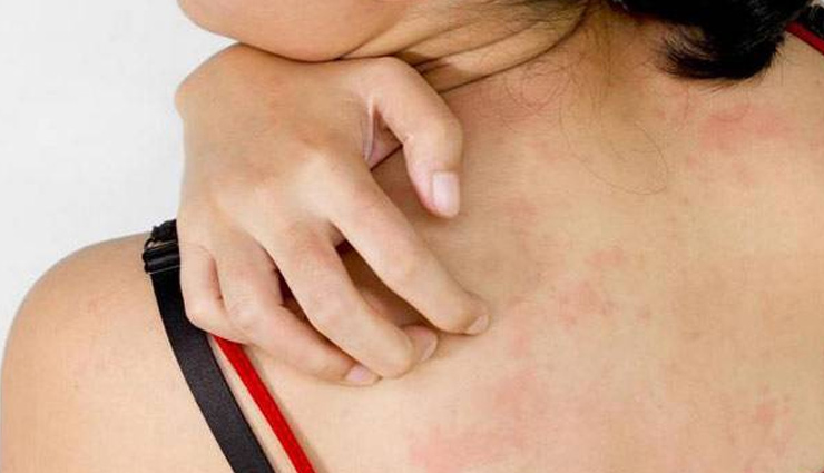  घमौरियों की समस्या से परेशान है तो ले इन घरेलू उपायों की मदद, मिनटों में मिलेगा आराम