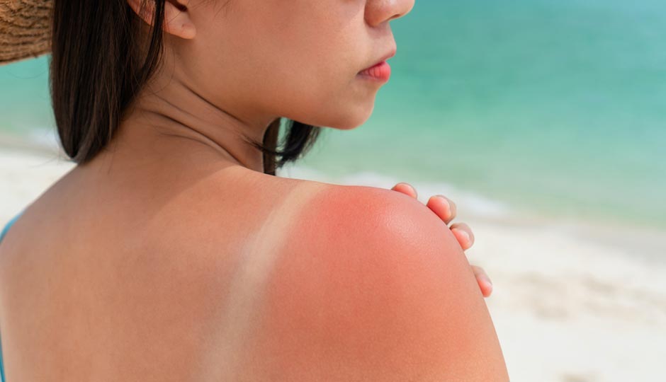 9 Effective Home Remedies To Treat Sun Burn