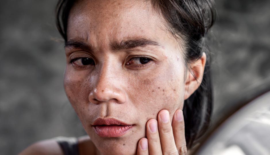 7 Effective Home Remedies To Treat Sun Burn Patches on Skin