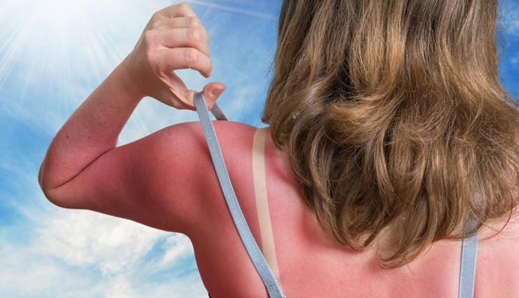 4 Ayurvedic Remedies To Treat Sun Tan Naturally