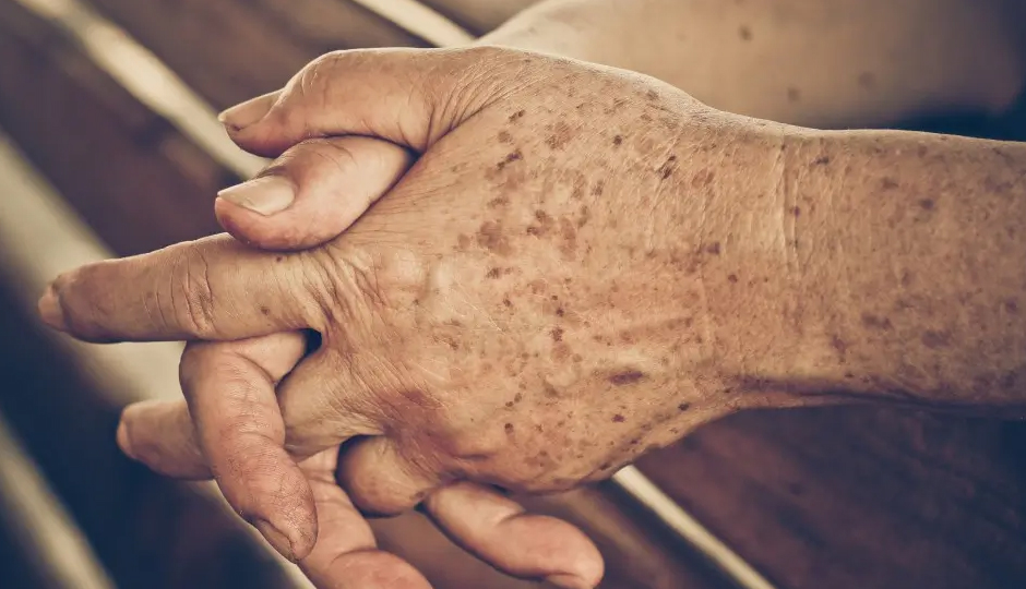 8 DIY Ways To Treat Sun Damage on Hands