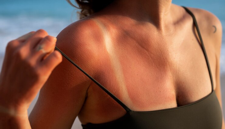 8 DIY Ways To Get Rid of Sun Tan