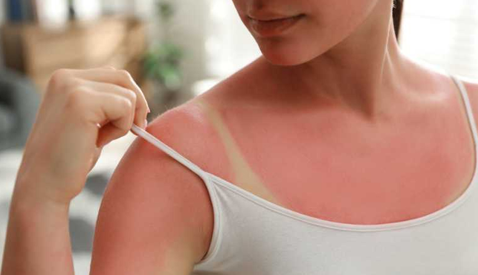 8 DIY Ways To Treat Sun Tan