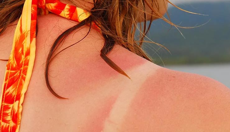 home remedies,home remedies to treat sunburn,sunburn,beauty tips,skin care tips