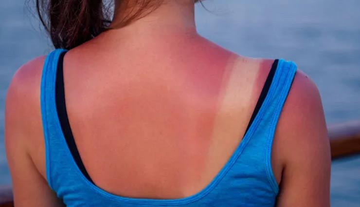 5 Home Remedies To Treat Sunburn