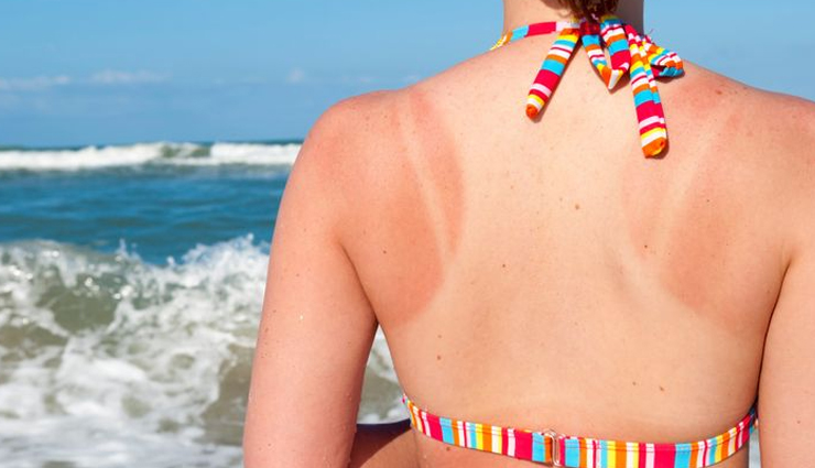 गर्मियों में आम हैं सनबर्न की समस्या, इससे निजात पाने के लिए आजमाए ये नुस्खें 