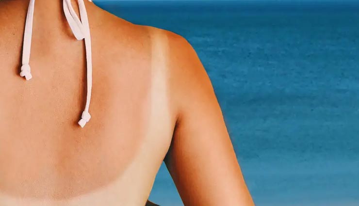 home remedies,home remedies to treat sunburn,sunburn,beauty tips,skin care tips