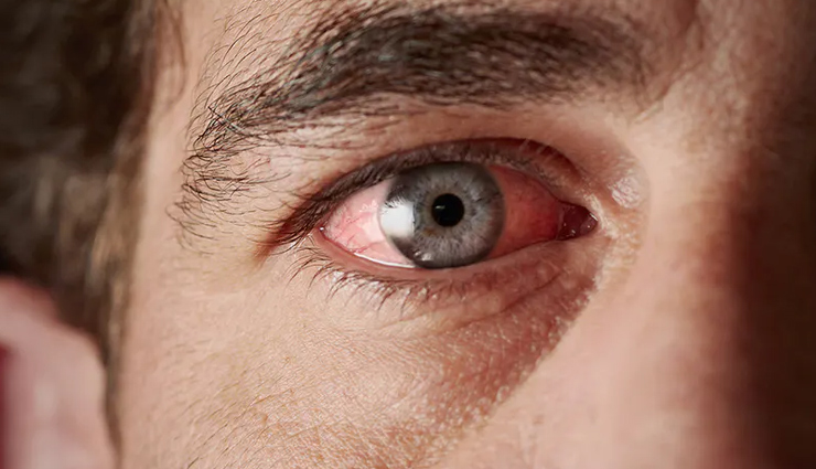 home remedies to treat sunburn eyes,sunburn eyes,eye care tips,Health tips,summer eye care tips,fitness tips