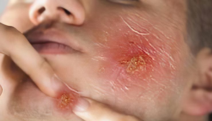 Sunscreen,side effects of using sunscreen,skin care tips,beauty tips