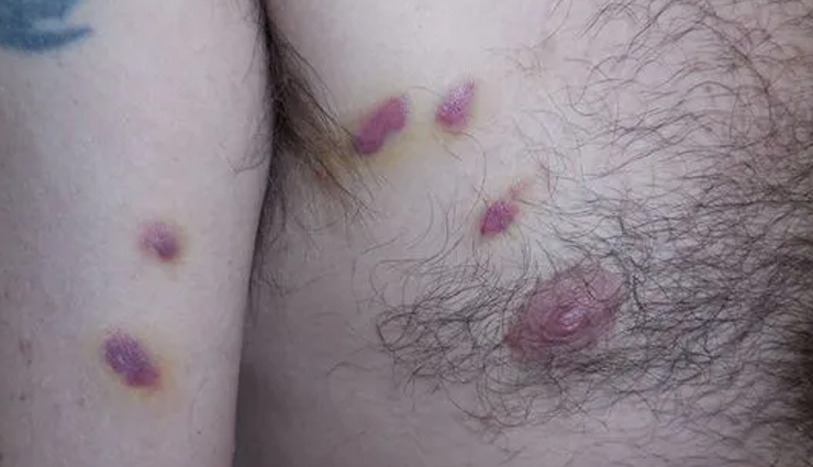 Sunscreen,side effects of sunscreen,sunscreen for skin,beauty tips,skin care tips