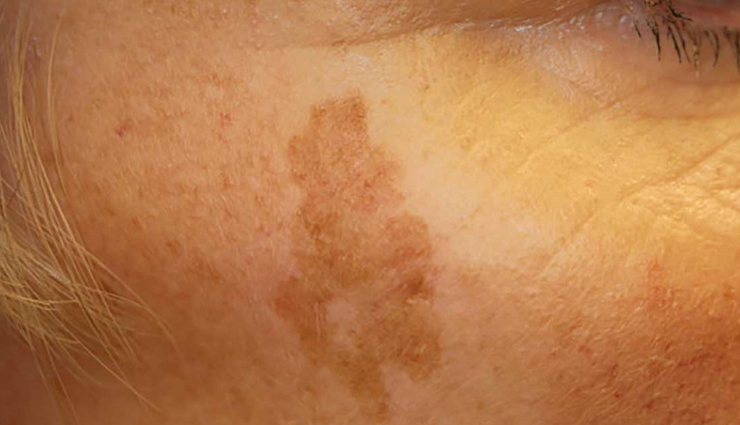 7 DIY Remedies To Treat Sunspots at Home