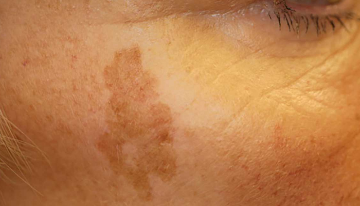 7 DIY Remedies To Treat Sunspots