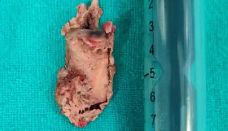 जयपुर: महिला के गले में फंसी थी 4 सेमी. की सुपारी, बिना चीरा लगाए ब्रॉनकोस्कोपी से निकाली