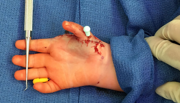 mirror hand syndrome diagnosis,treatment for mirror hand syndrome,mirror hand syndrome therapy,mirror hand syndrome rehabilitation,coping with mirror hand syndrome,mirror hand syndrome management,mirror hand syndrome prognosis,mirror hand syndrome symptoms,mirror hand syndrome causes,mirror hand syndrome specialist,mirror hand syndrome exercises,mirror hand syndrome physiotherapy,mirror hand syndrome research,mirror hand syndrome neurology,mirror hand syndrome rehabilitation exercises,mirror hand syndrome specialists,mirror hand syndrome physical therapy,coping strategies for mirror hand syndrome,mirror hand syndrome case studies,mirror hand syndrome prognosis and outlook,mirror hand syndrome surgical options,mirror hand syndrome therapies,mirror hand syndrome neurological disorder