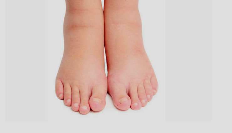 मधुमेह रोगी के लिए पैरों की सूजन है बड़ी समस्या, दूर करें इन आसान उपायों से