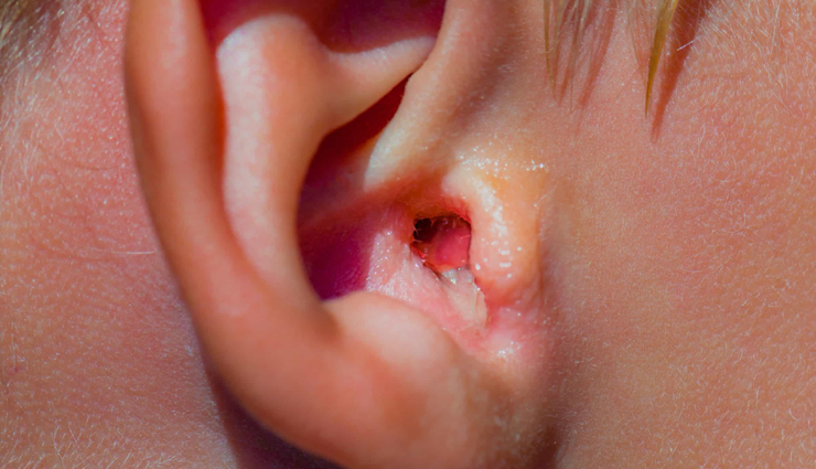 7 Home Remedies For Swimmer's Ear