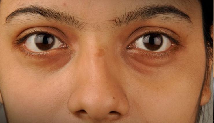 आँखों से बार-बार पानी आना और खुजली होने पर करें ये घरेलू उपाय swollen eyes,home remedies,health tips for swollen eyes,Health tips,Health