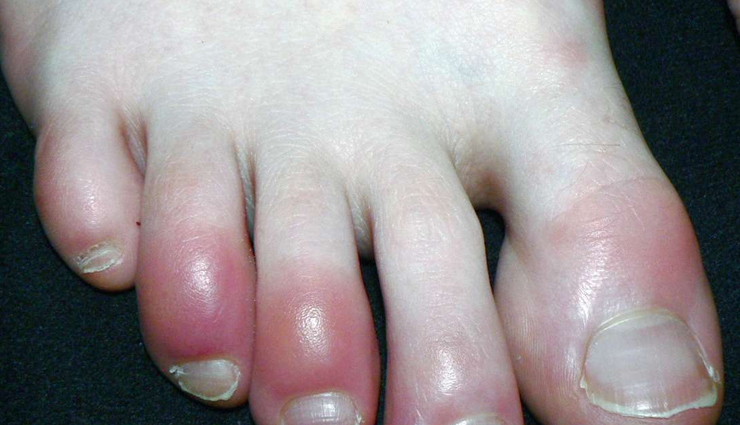 heart diseases that appear on your skin,heart diseases,healthy living,Health tips