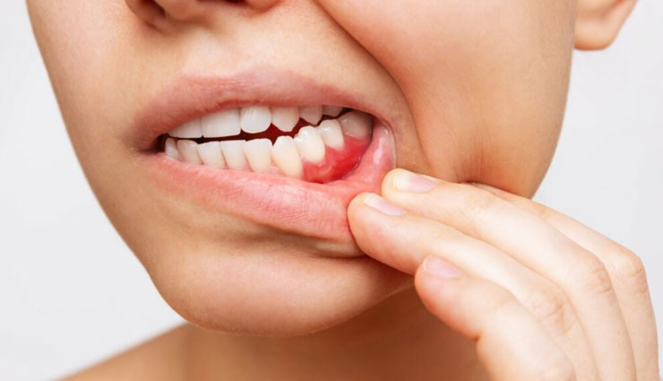 10 Effective Home Remedies To Treat Swollen Gums