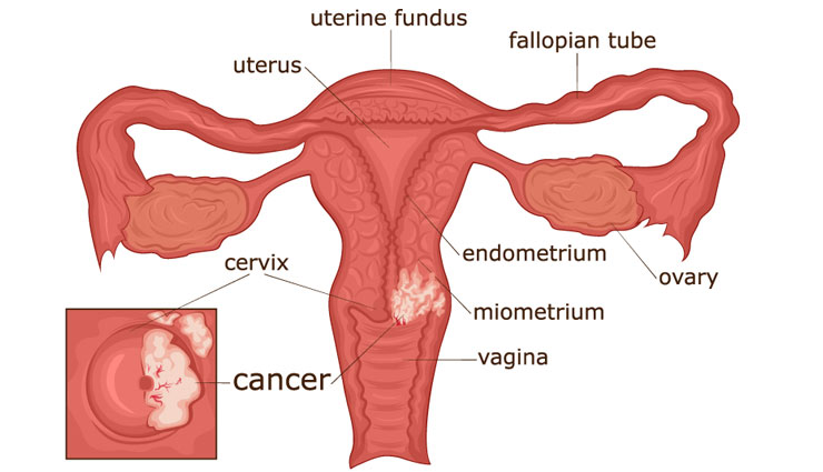 symptoms of cervical cancer,cervical cancer,symptoms of cancer,cancer tips,Health tips,fitness tips