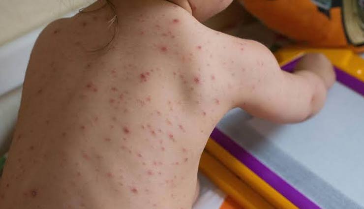 chicken pox,symptoms of chicken pox,Health tips,fitness tips