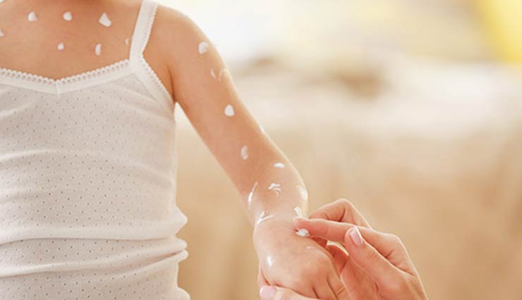 5 Major Symptoms of Chicken Pox