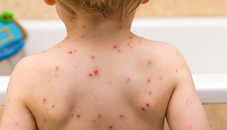 chicken pox,symptoms of chicken pox,Health tips,fitness tips