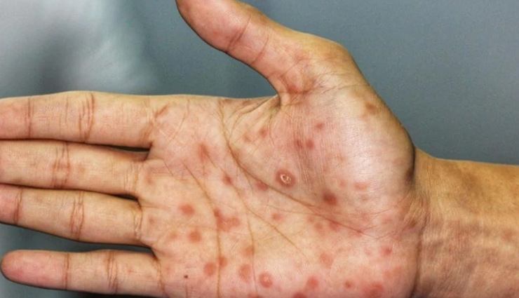 health benefits of sarsaparilla,healthy living,Health tips