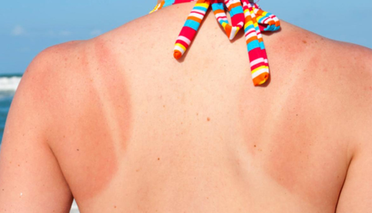 6 Remedies That Will Help You Get Rid of Tan Naturally at Home
