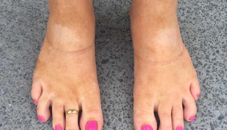 7 Effective Home Remedies to Treat Tanning on Feet