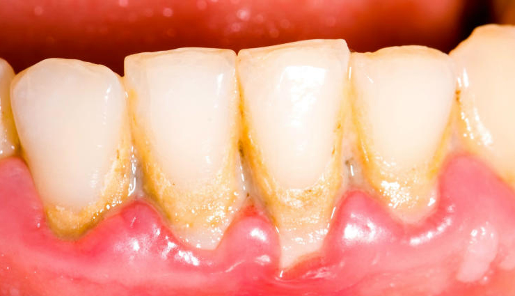 7 Effective Remedies To Get Rid of Tartar in Teeth