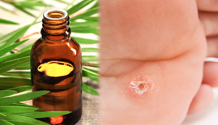 tea tree oil for skin,tea tree oil benefits,tea tree oil for face,tea tree oil used in allergy,tea tree oil remove bacterial infection,tea tree oil for warts,tea tree oil for breath and body odour,tea tree oil for dry skin and chapped lips,tea tree oil for wounds,beauty,beauty tips