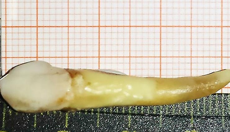 डॉक्टर ने एक शक्स के मुंह से निकाला 3.7 सेंटीमीटर लंबा दांत, गिनीज वर्ल्ड रिकॉर्ड्स में दर्ज हुआ नाम