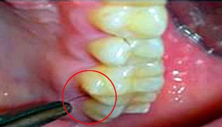 woman,hair,gums,teeth,bizzare,surprising,italian,pcos,polycystic ovary syndrome,testosterone,weird news