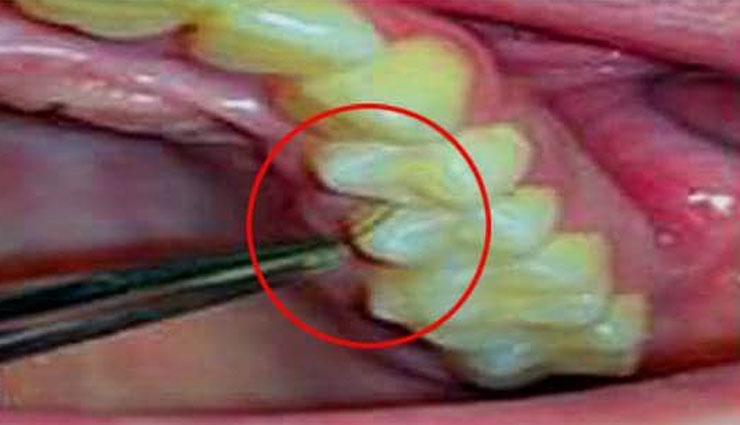 woman,hair,gums,teeth,bizzare,surprising,italian,pcos,polycystic ovary syndrome,testosterone,weird news