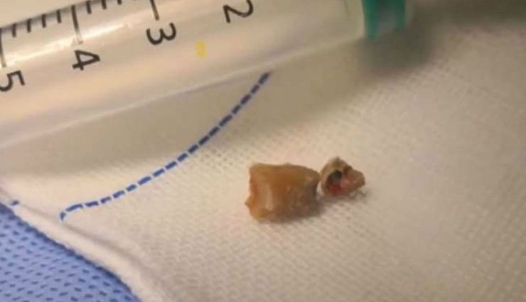 शख्स  की नाक में उग गया था दांत, 30 मिनट की सर्जरी के बाद डॉक्टर ने निकाला