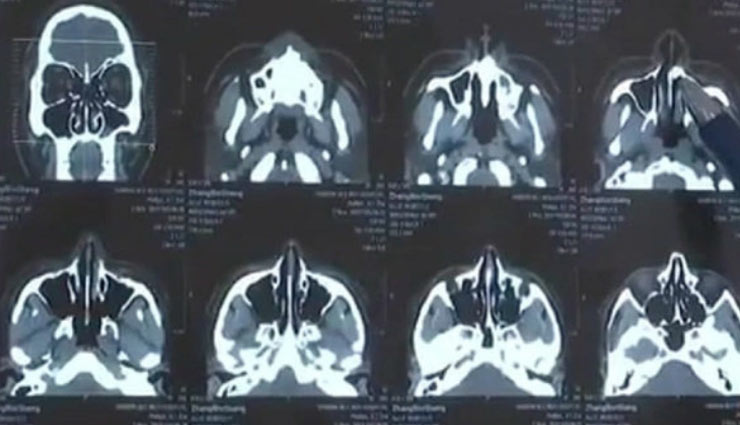 weird news in hindi,zhang binsheng,blocked nose,doctors,tooth,xray,china