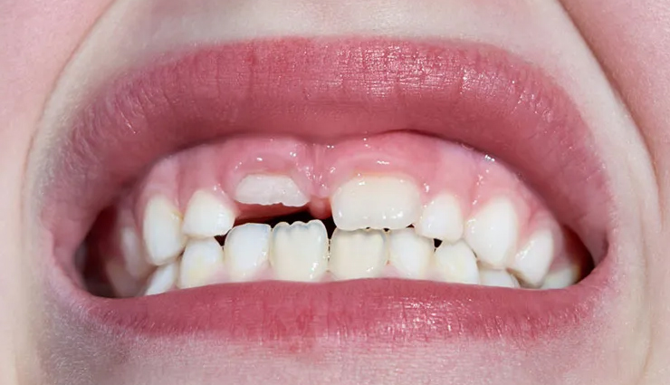 drawbacks of biting nails,biting nails problem,nails,Health,Health tips