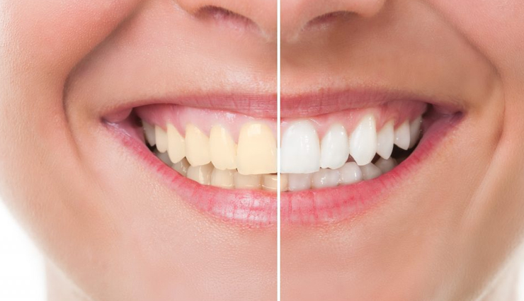 Top 10 Foods That Causes Staining in Teeth