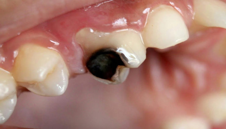 बच्चों के दांतों में लगा कीड़ा बन रहा परेशानी का कारण, इन आसान से उपायों से पाए छुटकारा Health tips,home remedies,teeth worm,children teeth worm,children health care