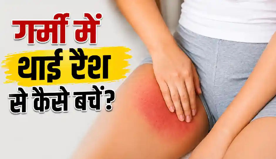 गर्मी में थाई रैश से हैं परेशान? बचाव और जल्दी ठीक करने के असरदार उपाय जानें