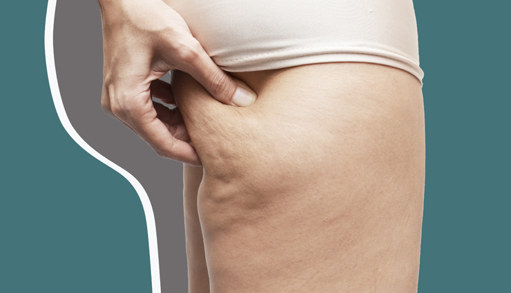 5 Natural Remedies To Get Rid Off Cellulite
