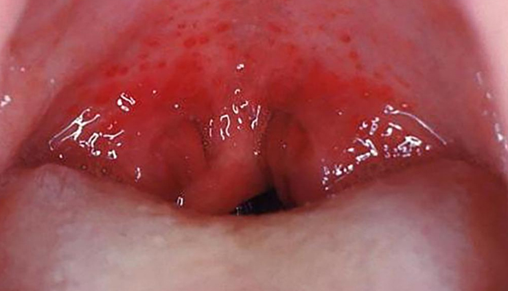 side effects of apple cider vinegar,risks of using apple cider vinegar,negative effects of apple cider vinegar,apple cider vinegar: potential side effects,health concerns of using apple cider vinegar,beware of apple cider vinegar side effects,apple cider vinegar usage and its drawbacks,is apple cider vinegar safe? side effects,adverse reactions to apple cider vinegar,apple cider vinegar: unwanted effects,possible consequences of apple cider vinegar use,health issues linked to apple cider vinegar,apple cider vinegar precautions and side effects,managing risks of apple cider vinegar,balancing benefits and risks: apple cider vinegar